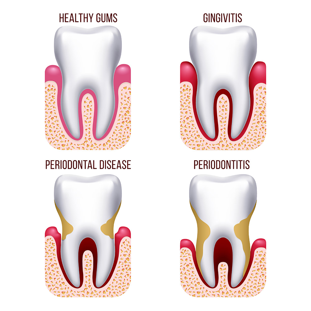 Graphic design image showing 4 teeth and the stages of gingivitis